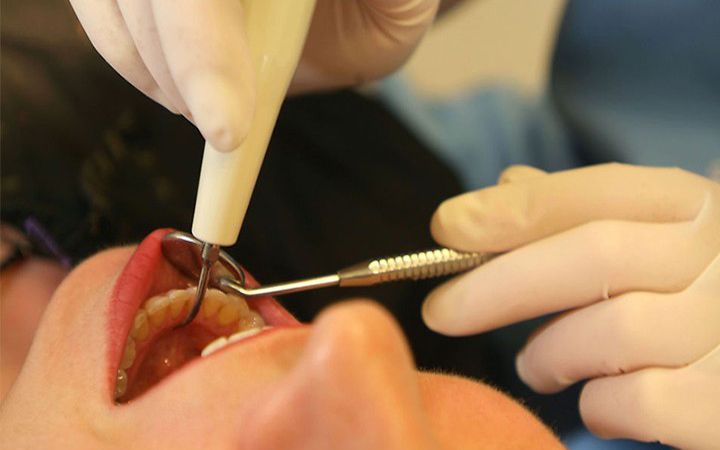 微創(chuàng)無痛拔牙